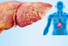 وزارة الصحة تحذر من تجاهل أعراض "الكبد الدهني" وتكشف عن أبرز طرق الوقاية والعلاج