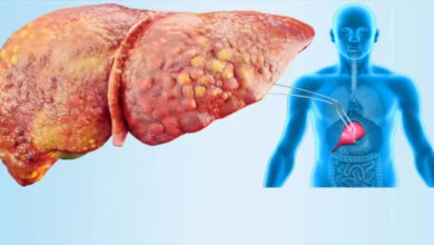 وزارة الصحة تحذر من تجاهل أعراض "الكبد الدهني" وتكشف عن أبرز طرق الوقاية والعلاج