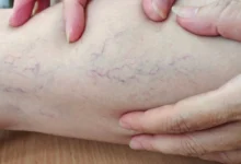 طرق طبيعية لتخفيف أعراض الدوالي وتحسين الدورة الدموية في الساقين