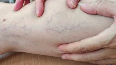 طرق طبيعية لتخفيف أعراض الدوالي وتحسين الدورة الدموية في الساقين