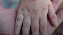 اكتشاف حالات جدري مائي بين طلاب مدرسة في الباجور بالمنوفية