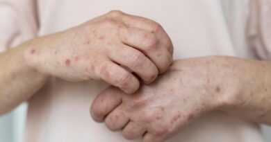 تفشي الحصبة يضرب كارولينا الجنوبية: 310 إصابات جديدة و200 في الحجر الصحي خلال أسبوع واحد